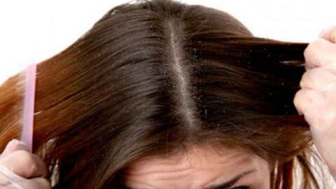 وصفات لعلاج قشرة الشعر