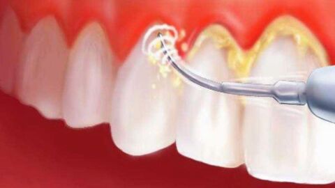 إزالة الجير من الأسنان بطرق طبيعية