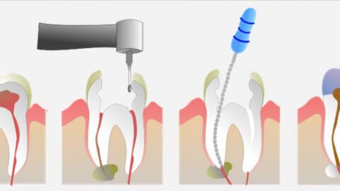 آثار جانبية لسحب عصب الأسنان