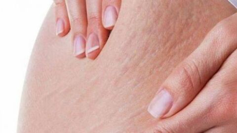 علامات تمدد الجلد أثناء الحمل