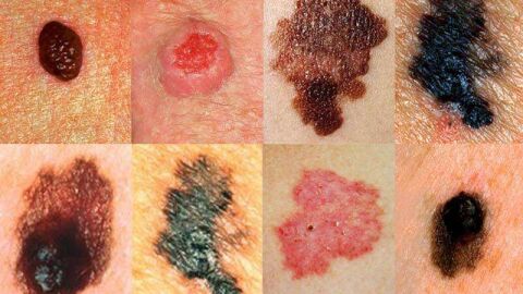 أعراض سرطان الجلد