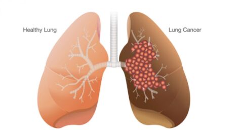 مراحل تطور مرض سرطان الرئة