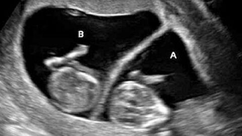 مراحل تكوين الجنين التوأم