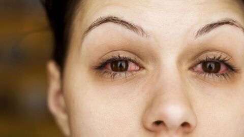 أعراض التهاب الملتحمة في العين