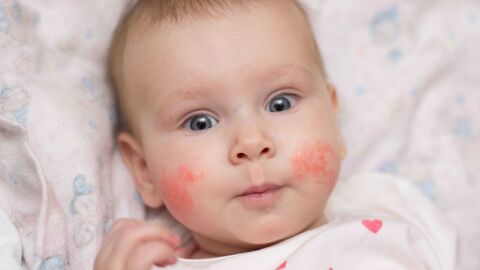 أعراض حساسية البيض عند الرضع
