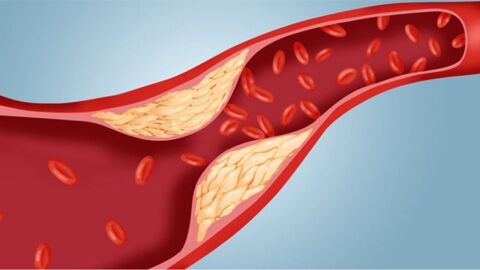 أعراض ارتفاع نسبة الكولسترول في الدم