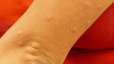 أعراض مرض حساسية الجلد