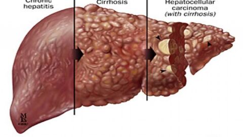 أعراض فيروس الكبد