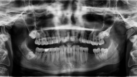 أضرار أشعة الأسنان للحامل
