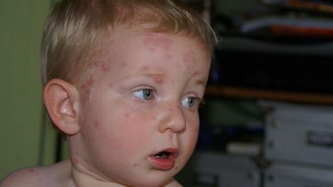 أفضل علاج للطفح الجلدي عند الأطفال