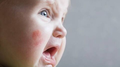أسباب ظهور حساسية الجلد عند الأطفال