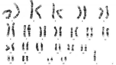 عدد الكروموسومات في متلازمة تيرنر
