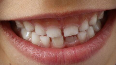 عدد الأسنان اللبنية والدائمة