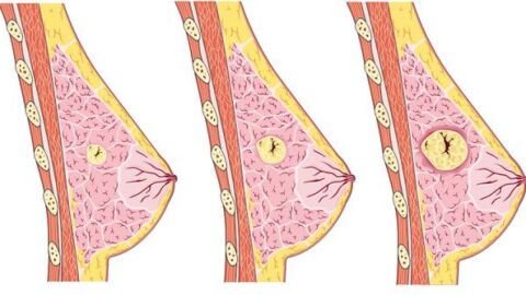 شكل الورم السرطاني في الثدي