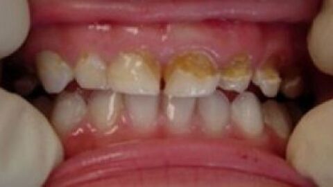 علاج تسوس الأسنان عند الأطفال
