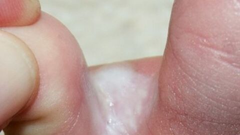 علاج الفطريات بين أصابع القدمين