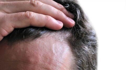 علاج الفطريات في الشعر