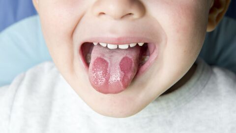 علاج الفطريات في الفم