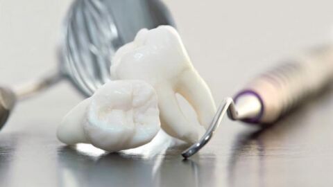 علاج ضعف مينا الأسنان