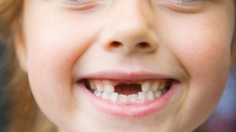 علاج تسوس الأسنان اللبنية عند الأطفال