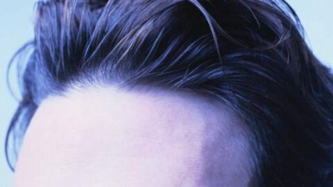 علاج تساقط الشعر من مقدمة الرأس