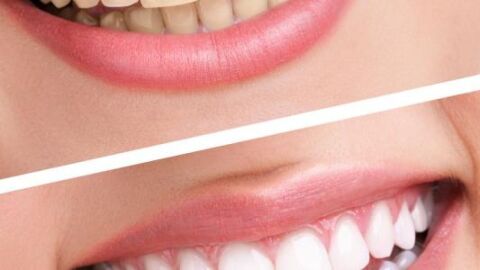 فوائد الكركم للأسنان
