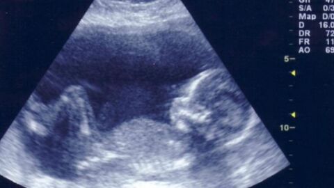 طرق معرفة نوع الجنين في الشهر الأول