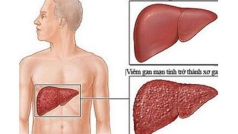 ما هي أسباب تشمع الكبد