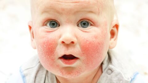 ما أسباب الطفح الجلدي عند الأطفال