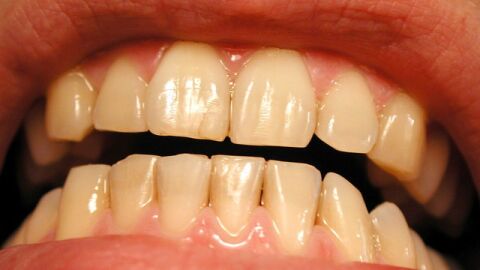 ما أسباب اصفرار الأسنان