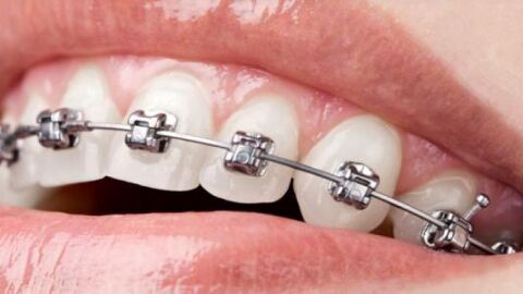 ما هي أضرار تقويم الأسنان - فيديو