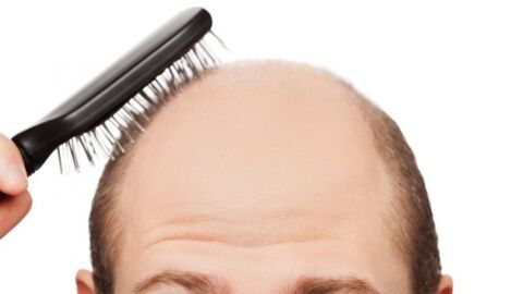 ما هي الأمراض التي تسبب تساقط الشعر