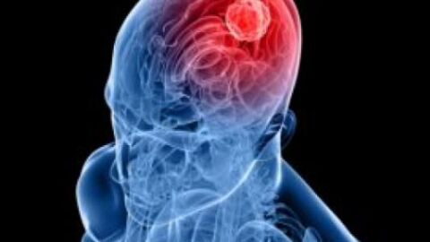 ما هي أعراض نزيف الدماغ