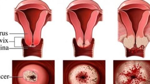 ما هي أعراض سرطان عنق الرحم