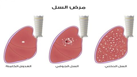 ما هي أنواع أمراض الرئة
