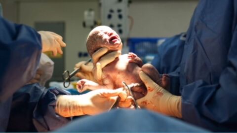 ما هي الولادة القيصرية - فيديو