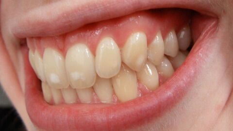 ما سبب ظهور بقع بيضاء على الأسنان