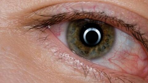ما علاج تورم العين