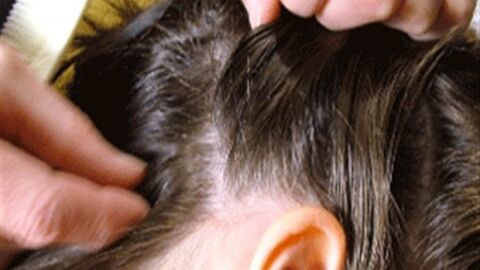 ما هو علاج قمل الشعر