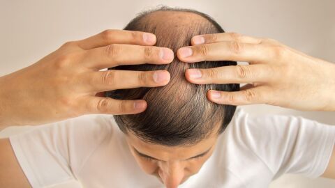 ما علاج تساقط الشعر عند الرجال