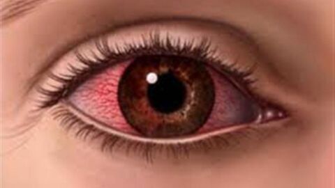ما علاج احمرار العين