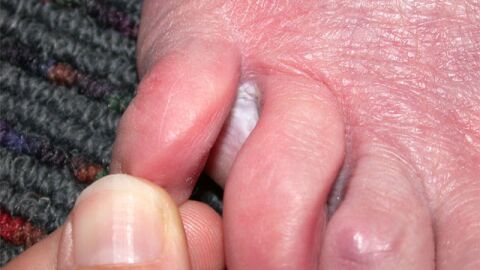 ما علاج الفطريات بين اصابع القدم