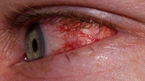 التهاب بياض العين