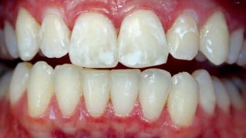البقع البيضاء في الأسنان