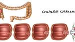 سرطان القولون هل هو مميت