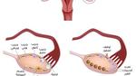 الأكياس على المبايض وكيف يمكن علاجها
