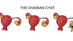 التخلص من كيس على المبيض