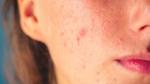 كيف أتخلص من حب الشباب بسرعة