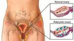 كيف يتم علاج تكيس المبايض