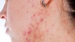 كيفية علاج حب الشباب للبشرة الدهنية